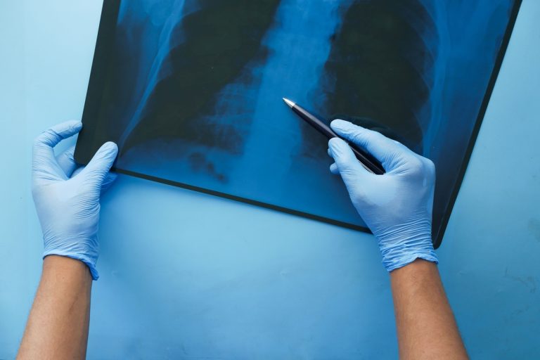 CONITEC abre consulta para Hipertensão Arterial Pulmonar